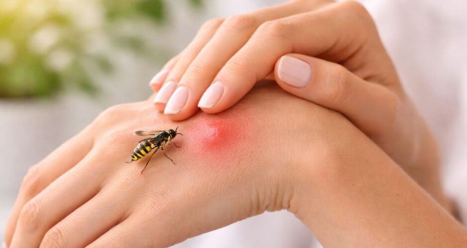 Letnie, naturalne ujęcie ręki lub ramienia po użądleniu owada z delikatnym chłodnym kompresem - subtelne skojarzenie z pierwszą pomocą po użądleniu osy