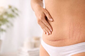 Subtelne, estetyczne ujęcie brzucha lub dolnej części brzucha po ciąży z delikatnym skojarzeniem z blizną po cesarce i rozstępami - kobiecy, dyskretny klimat