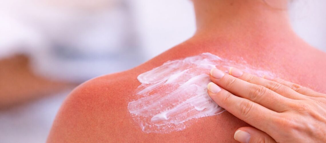 Skóra zaczerwieniona po słońcu i chłodny, kojący kadr w letnim świetle - subtelne skojarzenie z oparzeniem słonecznym i pierwszą pomocą dla skóry